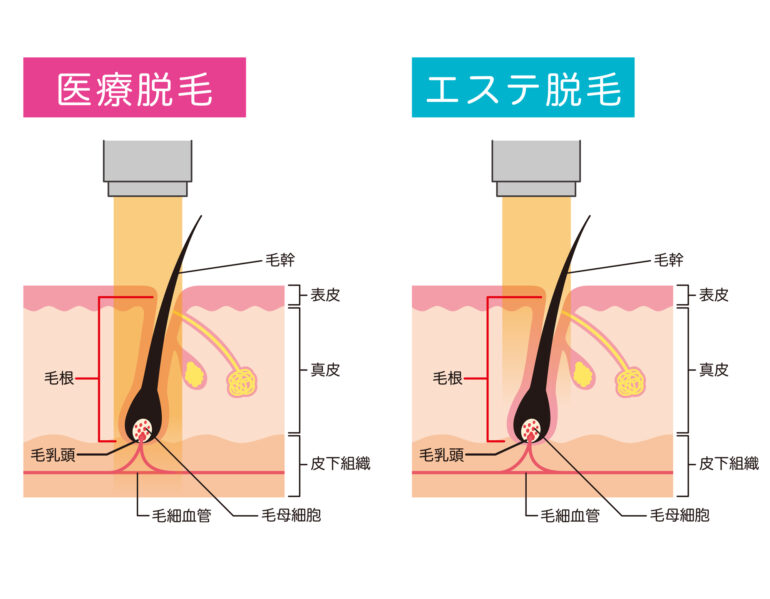 脱毛